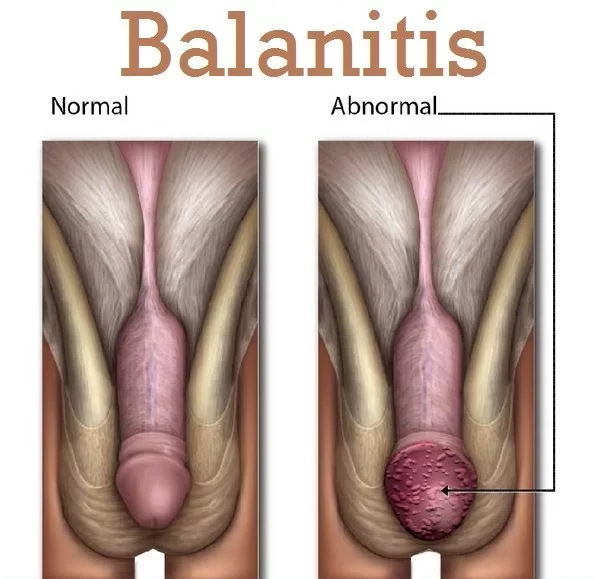 Balanitis | photo