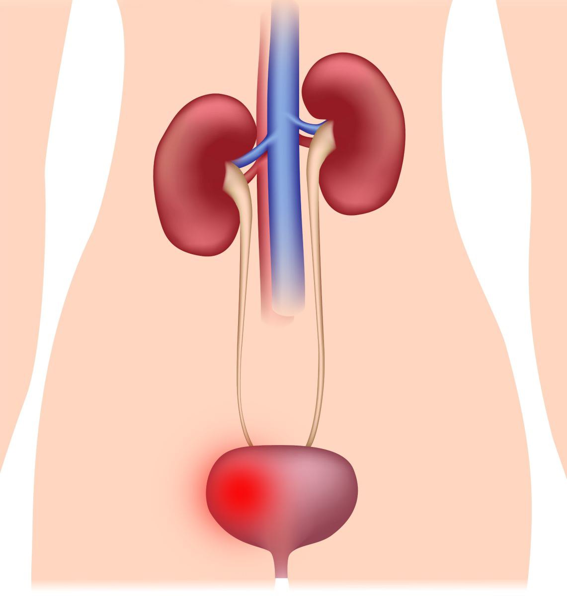 თირკმლის დაწევა, ნეფროპტოზი | ფოტო