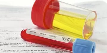 სისხლი შარდში | ფოტო