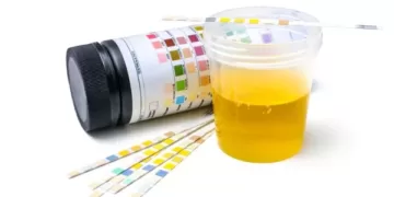 ცილა შარდში ალბუმინურია | ფოტო