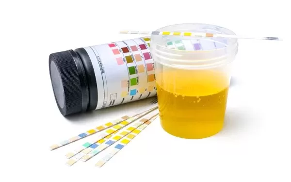 ცილა შარდში ალბუმინურია | ფოტო