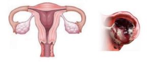 საკვერცხის აპოპლექსია