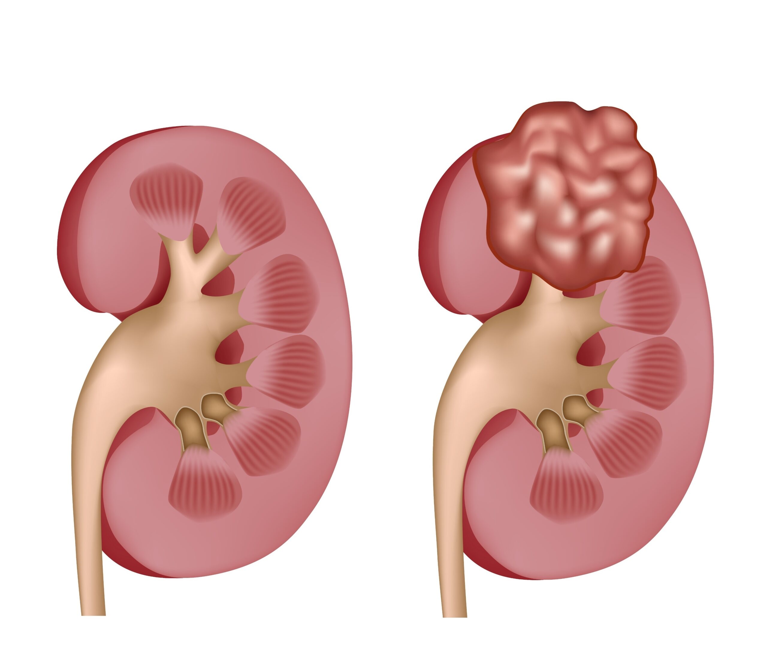 თირკმლის კიბო