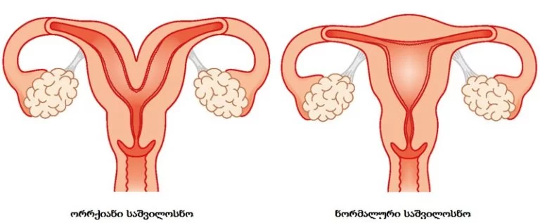 ორრქიანი საშვილოსნო | ფოტო