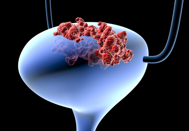 შარდის ბუშტის კიბო