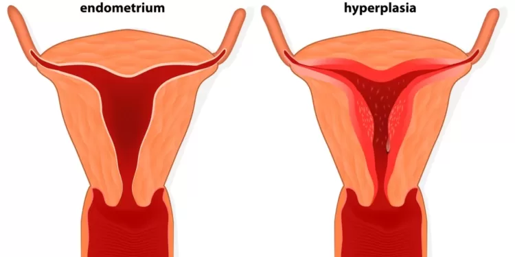 ენდომეტრიოზი | ფოტო