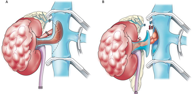 RADICAL NEPHRECTOMY1