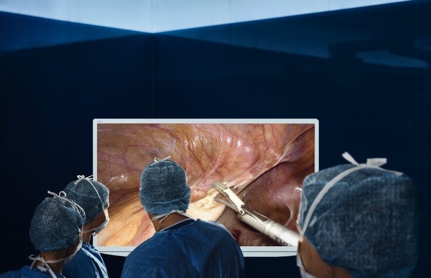laparoscopy