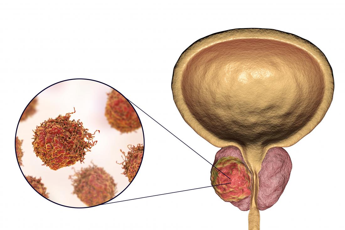 prostate cancer illustration
