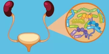 საშარდე გზების ინფექაცია | ფოტო