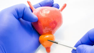 პროსტატა