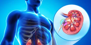 კენჭი თირკმელში | ფოტო