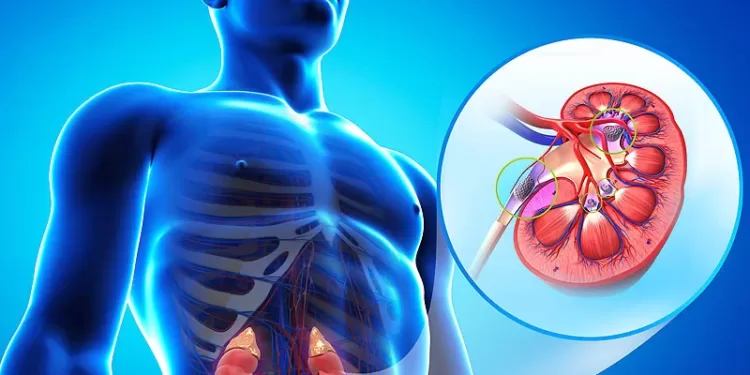 კენჭი თირკმელში | ფოტო