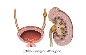 კენჭის გავლის პროცესი