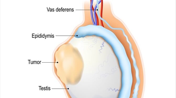 სათესლე ჯირკვლის კიბო
