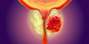 წინამდებარე ჯირკვლის კიბო