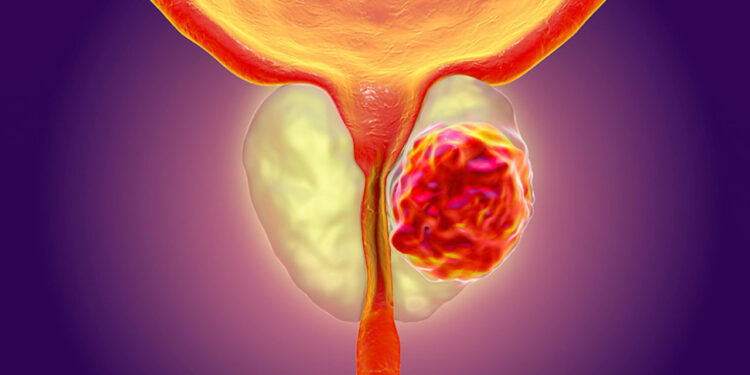 წინამდებარე ჯირკვლის კიბო