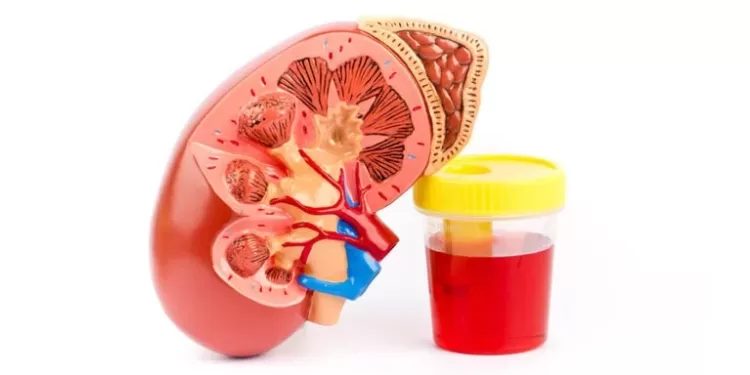 სისხლიანი შარდი | ფოტო