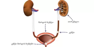 შარდის ბუშტის კენჭები | ფოტო