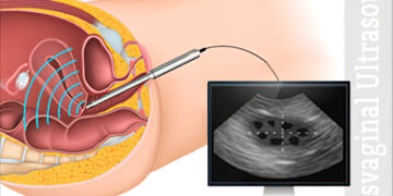 ვაგინალური ექოსკოპია
