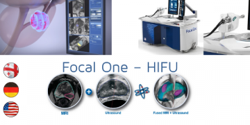 პროსტატის კიბოს მკურნლობის ახალი სტანდარტი Focal one – რუთი, გერმანიაში დაინერგა