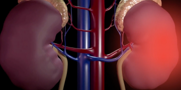 მორიგი კენჭის დაშლის წარმატებული პროცედურა