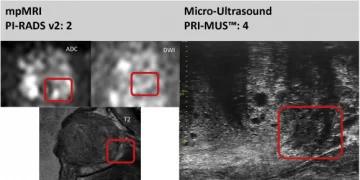 Сравнение микроультразвука и МРТ: последние данные Европейской Ассоциации урологии