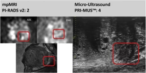слева МРТ и справа микроультразвук