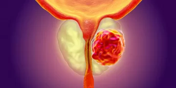 Симптомы рака простаты