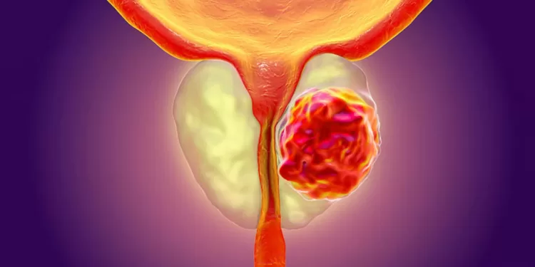 Симптомы рака простаты