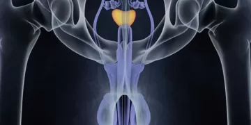 პროსტატის დაავადებები - კიბოთი დაავადების რისკის გამოთვლა