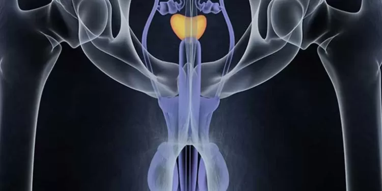 პროსტატის დაავადებები - კიბოთი დაავადების რისკის გამოთვლა