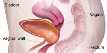 Cystocele illustration