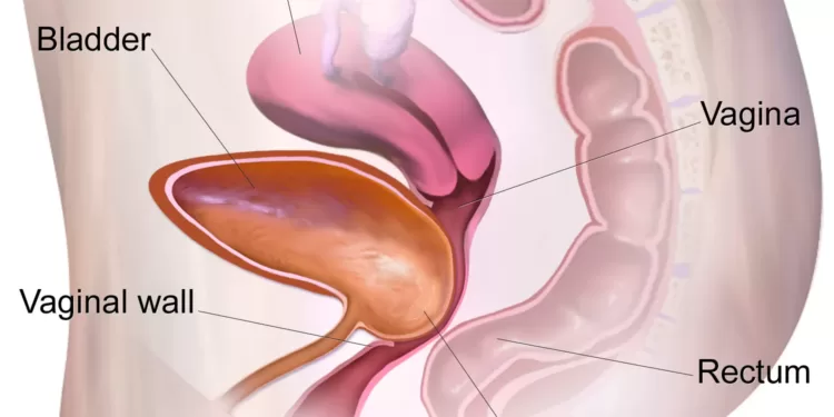 Cystocele illustration