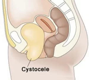 Cystocele | photo