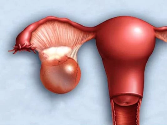 Ovarian cyst | Photo