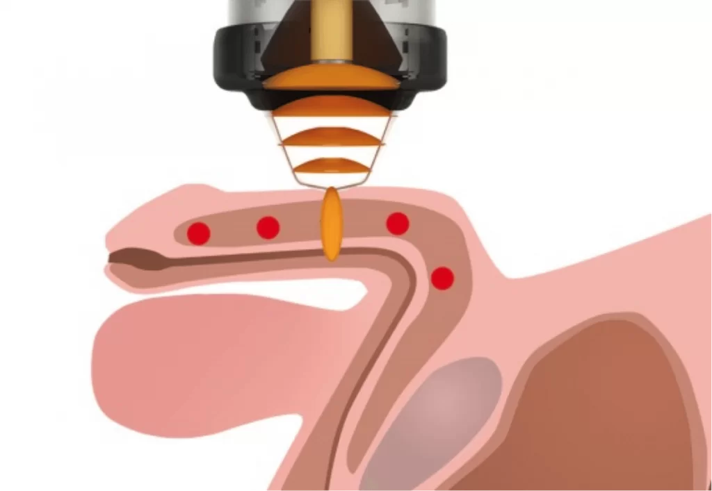 Лечение импотенции | фото