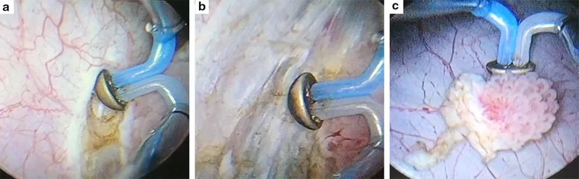 Лечение рака мочевого пузыря туром | фото 