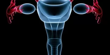 Что вызывает миому матки | фото