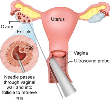 Что такое УЗИ влагалища | фото