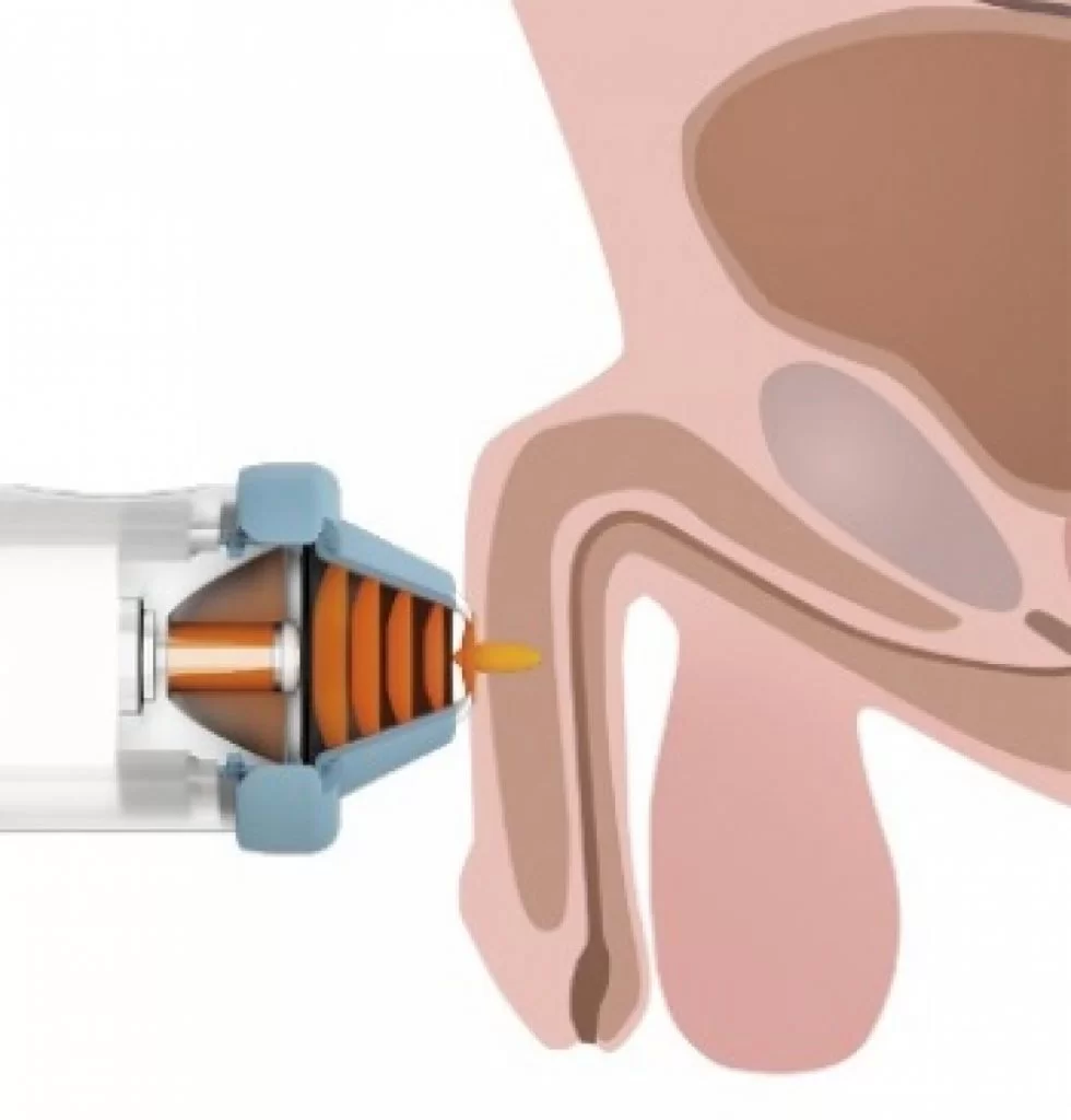 лечение эректильной дисфункции | фото