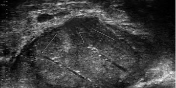 Micro ultrasound 29 MHz