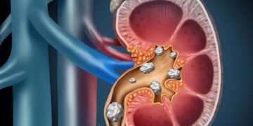 თირკმლის კენჭების წარმოქმნის პრევენცია შესაბამისი დიეტით და ჰიდრატაციის  როლი სხვა და სხვა ტიპის კენჭების დროს