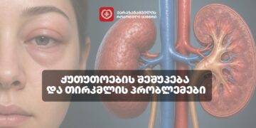 რა კავშირშია ქუთუთოების შეშუპება თირკმლის პრობლემებთან